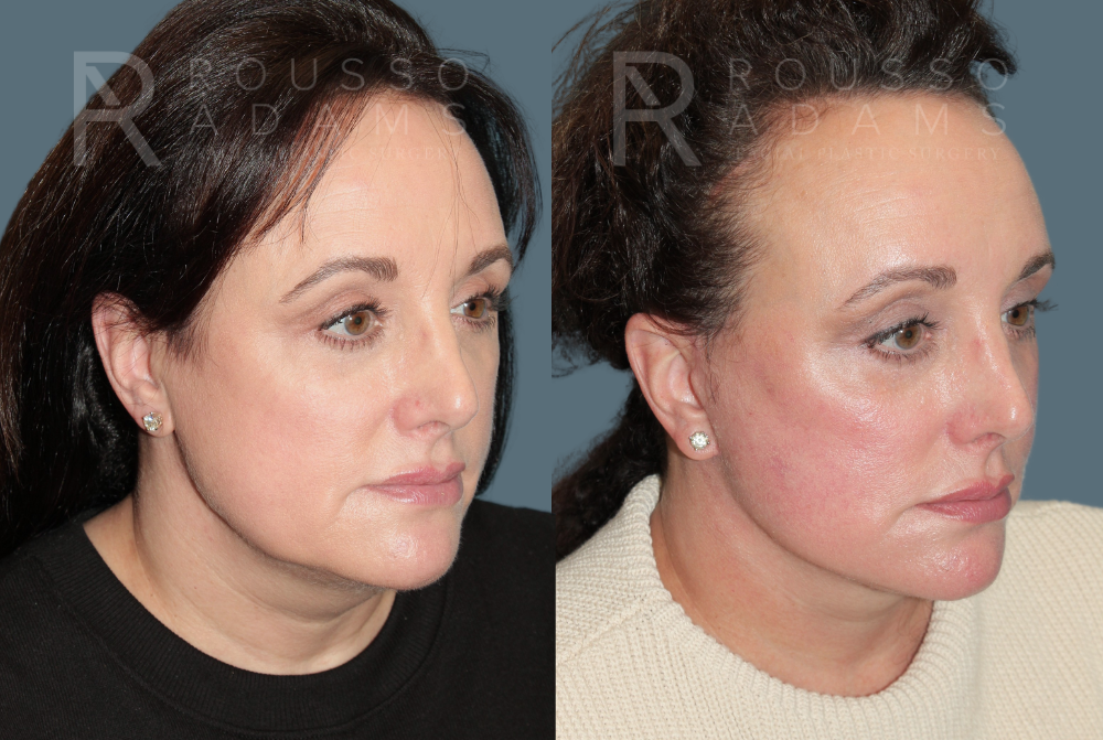 Deep Plane Facelift <span class=small>By Dr. Austin Adams</span> Before & After Gallery - Patient 375926 - Image 3