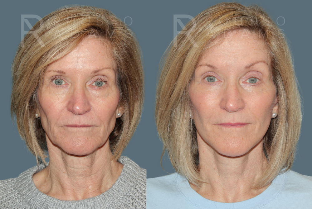 Deep Plane Facelift <span class=small>By Dr. Austin Adams</span> Before & After Gallery - Patient 395175 - Image 1