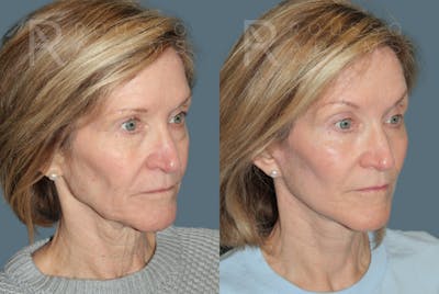 Deep Plane Facelift <span class=small>By Dr. Austin Adams</span> Before & After Gallery - Patient 395175 - Image 2