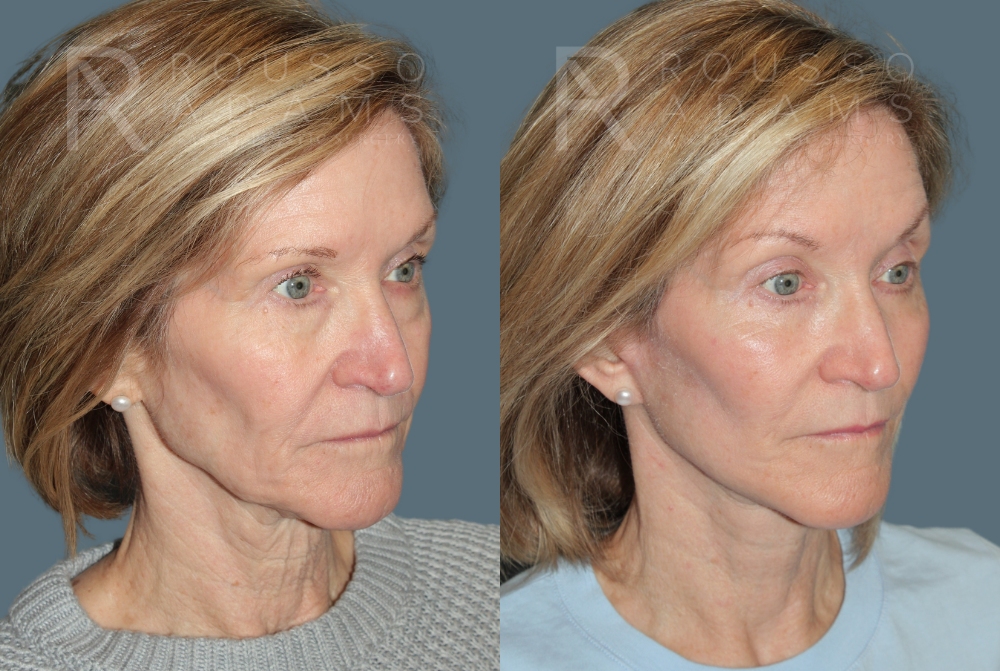 Deep Plane Facelift <span class=small>By Dr. Austin Adams</span> Before & After Gallery - Patient 395175 - Image 2