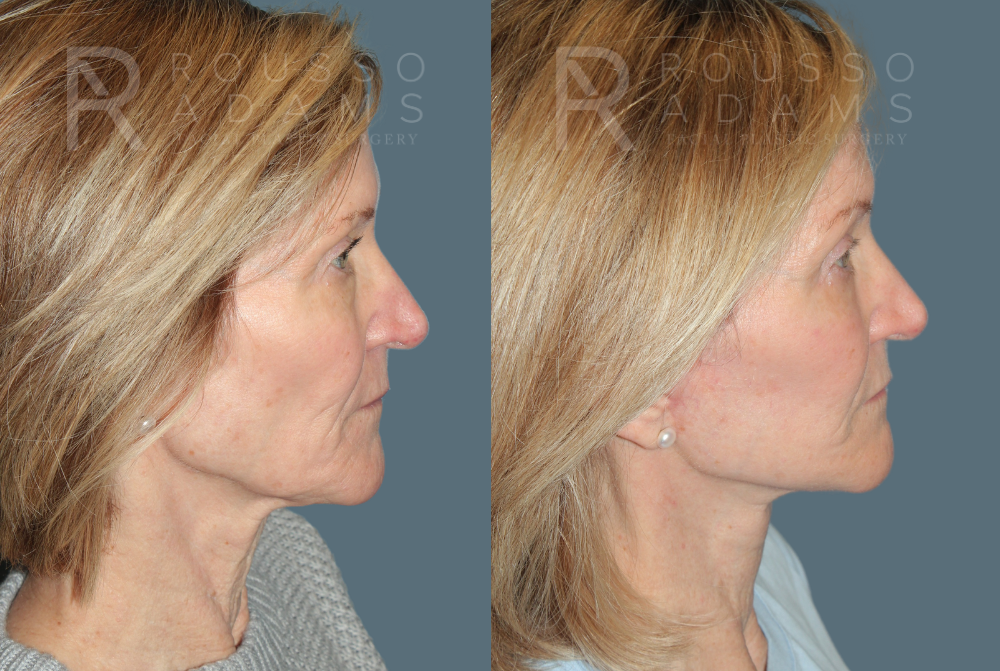 Deep Plane Facelift <span class=small>By Dr. Austin Adams</span> Before & After Gallery - Patient 395175 - Image 3