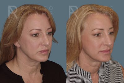 Facelift <span class=small>By Dr. Austin Adams</span> Before & After Gallery - Patient 414178 - Image 1