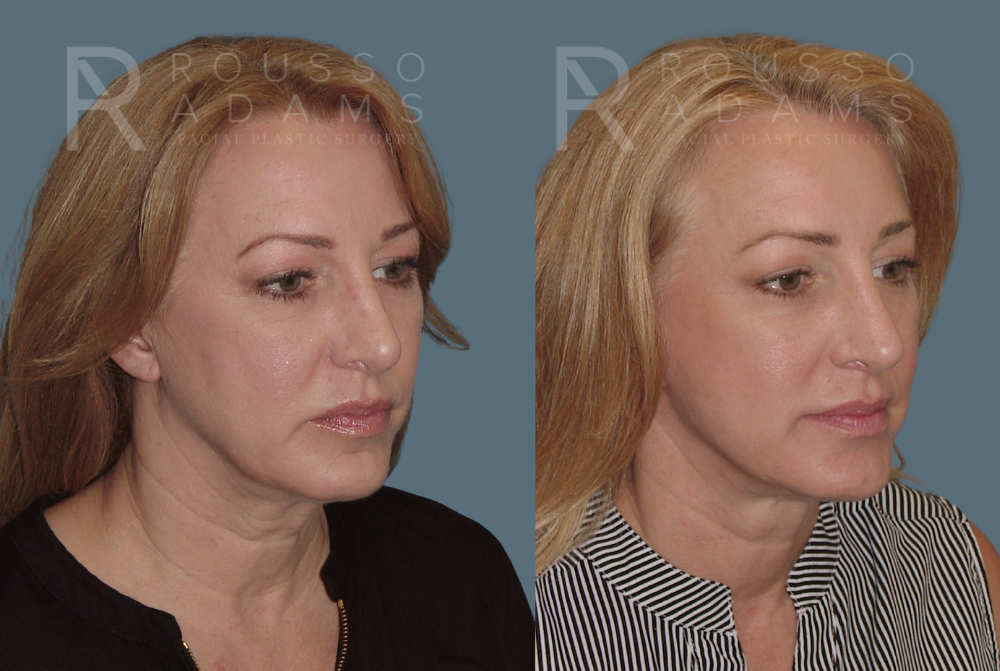 Facelift <span class=small>By Dr. Austin Adams</span> Before & After Gallery - Patient 414178 - Image 1