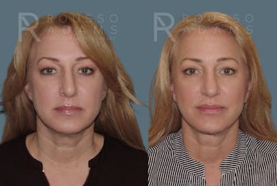 Facelift <span class=small>By Dr. Austin Adams</span> Before & After Gallery - Patient 414178 - Image 2