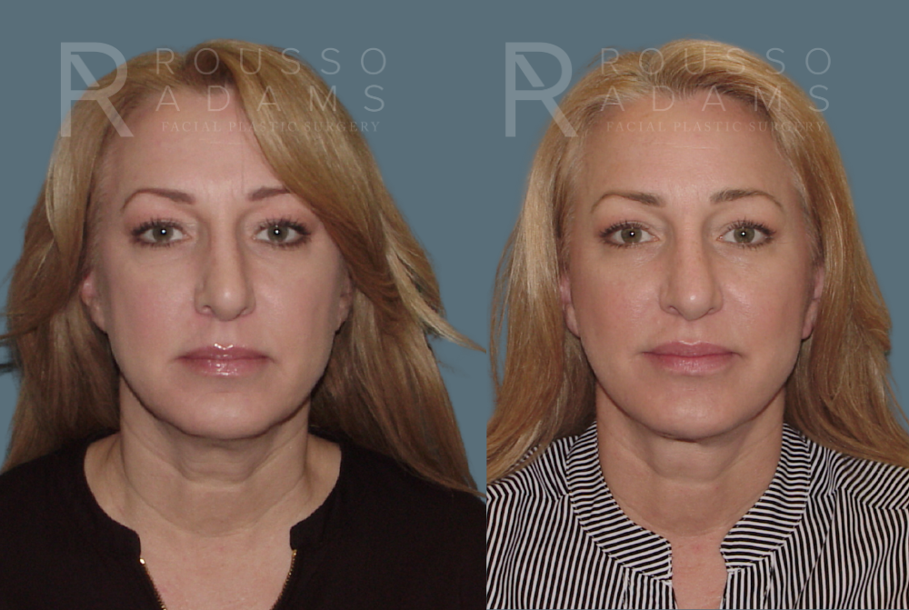 Facelift <span class=small>By Dr. Austin Adams</span> Before & After Gallery - Patient 414178 - Image 2