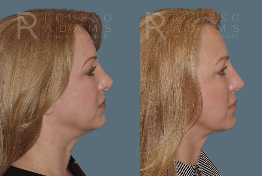 Facelift <span class=small>By Dr. Austin Adams</span> Before & After Gallery - Patient 414178 - Image 3