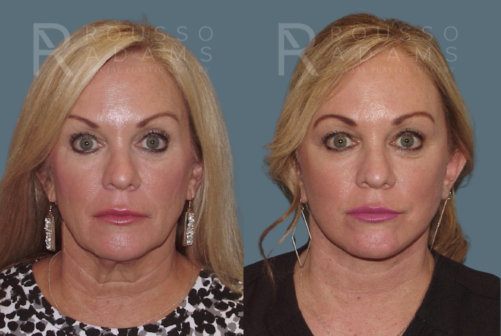 Facelift <span class=small>By Dr. Austin Adams</span> Before & After Gallery - Patient 230358 - Image 2