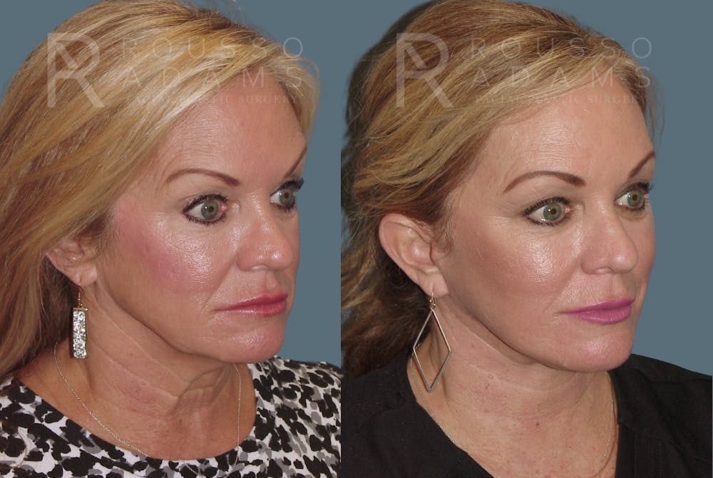 Before & After Image
