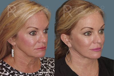 Facelift <span class=small>By Dr. Austin Adams</span> Before & After Gallery - Patient 230358 - Image 1