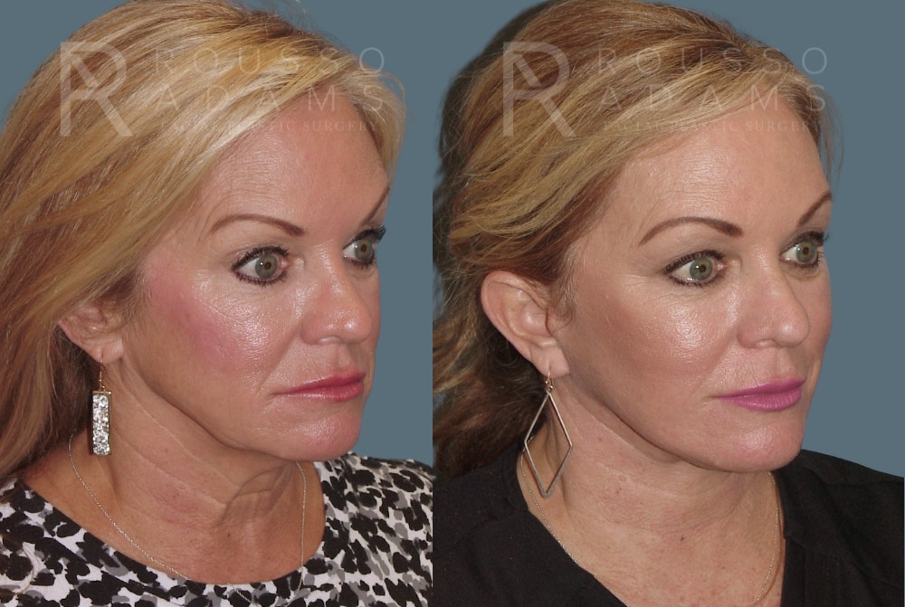 Facelift <span class=small>By Dr. Austin Adams</span> Before & After Gallery - Patient 230358 - Image 1