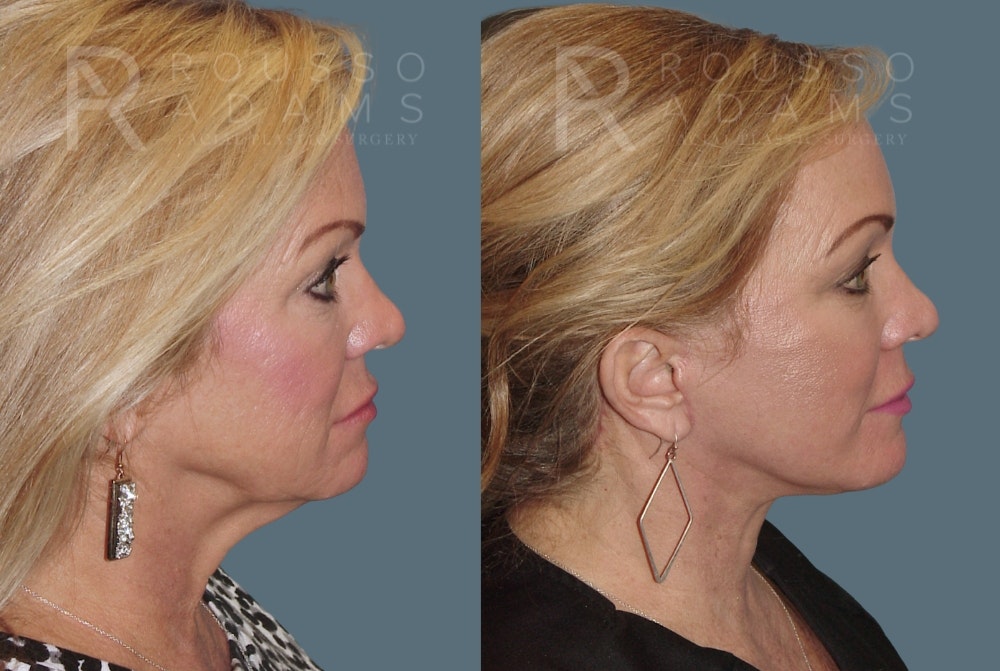 Facelift <span class=small>By Dr. Austin Adams</span> Before & After Gallery - Patient 230358 - Image 3