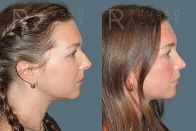Rhinoplasty<span class=small>By Dr. Austin Adams</span> Before & After Gallery - Patient 210946 - Image 1