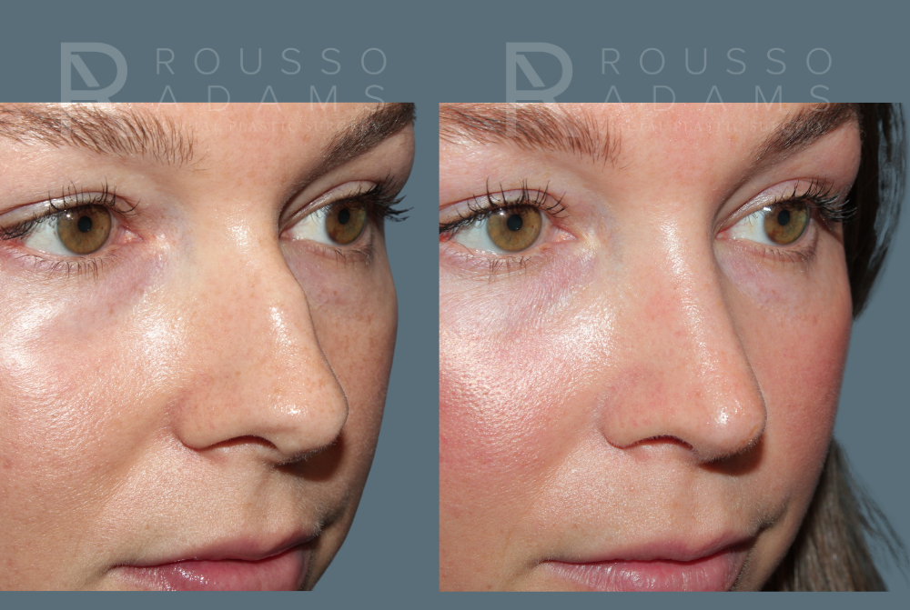Rhinoplasty<span class=small>By Dr. Austin Adams</span> Before & After Gallery - Patient 210946 - Image 4