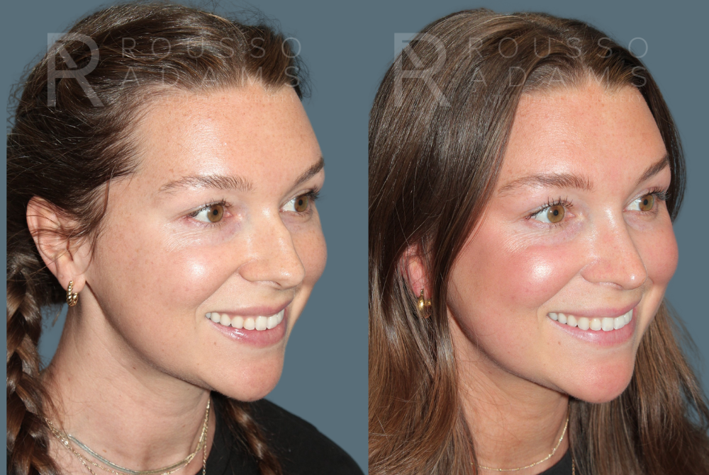 Rhinoplasty<span class=small>By Dr. Austin Adams</span> Before & After Gallery - Patient 210946 - Image 3