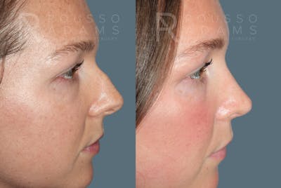 Rhinoplasty<span class=small>By Dr. Austin Adams</span> Before & After Gallery - Patient 210946 - Image 2