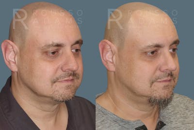 Rhinoplasty<span class=small>By Dr. Austin Adams</span> Before & After Gallery - Patient 407661 - Image 1