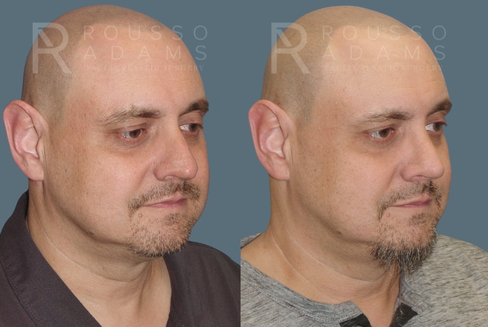 Rhinoplasty<span class=small>By Dr. Austin Adams</span> Before & After Gallery - Patient 407661 - Image 1