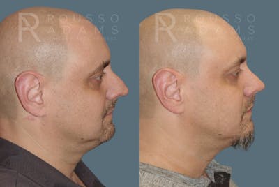 Rhinoplasty<span class=small>By Dr. Austin Adams</span> Before & After Gallery - Patient 407661 - Image 2