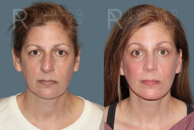 MiniLift<span class=small>By Dr. Austin Adams</span> Before & After Gallery - Patient 557629 - Image 1