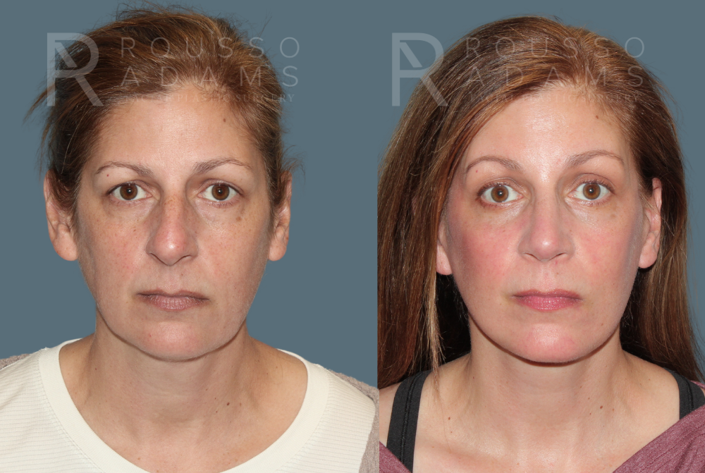 MiniLift<span class=small>By Dr. Austin Adams</span> Before & After Gallery - Patient 557629 - Image 1