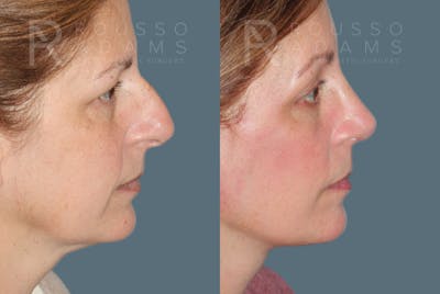 MiniLift<span class=small>By Dr. Austin Adams</span> Before & After Gallery - Patient 557629 - Image 2