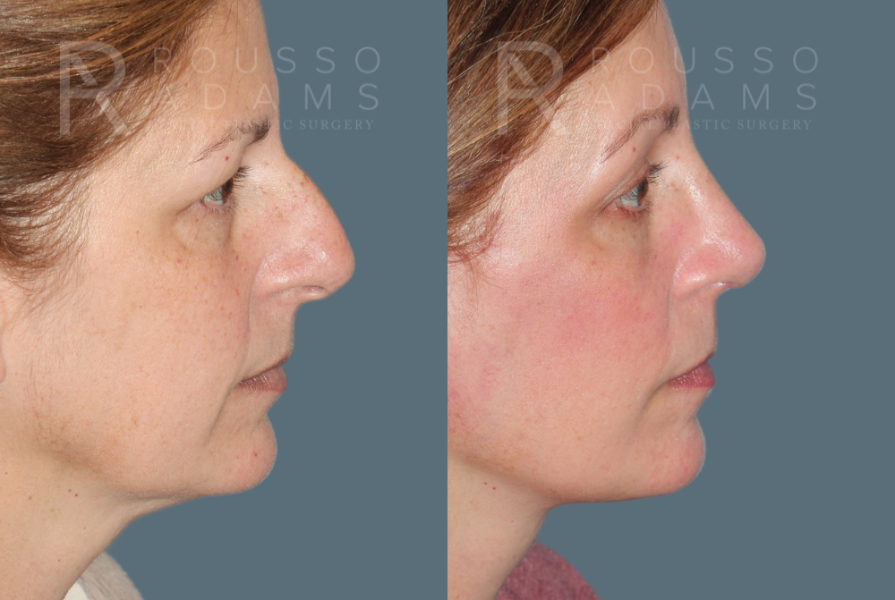 MiniLift<span class=small>By Dr. Austin Adams</span> Before & After Gallery - Patient 557629 - Image 2