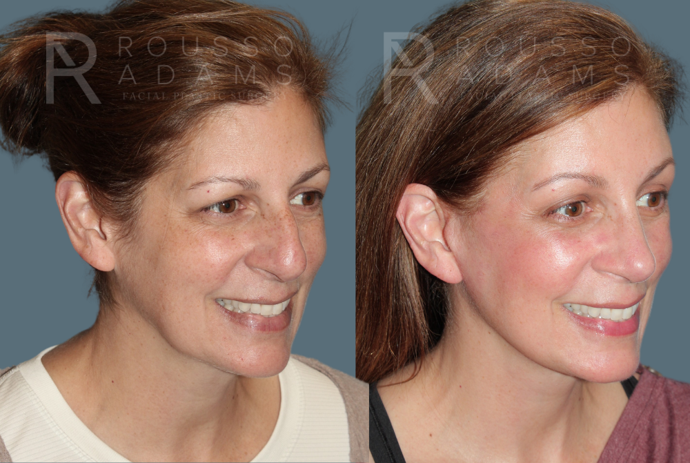 MiniLift<span class=small>By Dr. Austin Adams</span> Before & After Gallery - Patient 557629 - Image 3