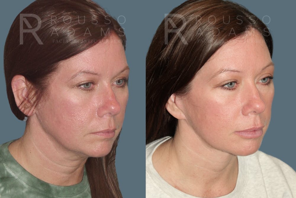 Before & After Image