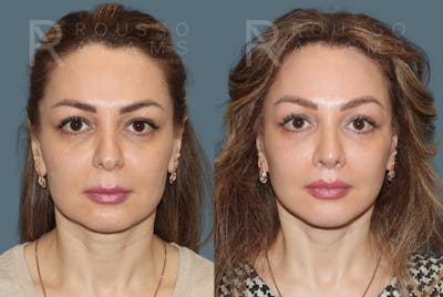 MiniLift<span class=small>By Dr. Austin Adams</span> Before & After Gallery - Patient 285443 - Image 1