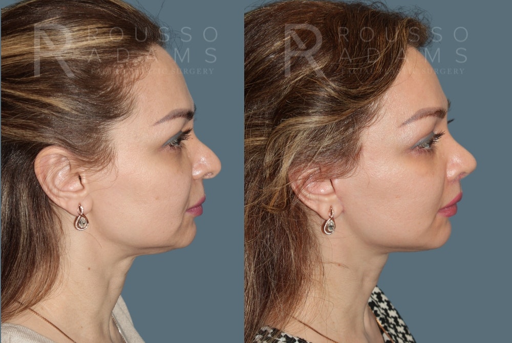 MiniLift<span class=small>By Dr. Austin Adams</span> Before & After Gallery - Patient 285443 - Image 3