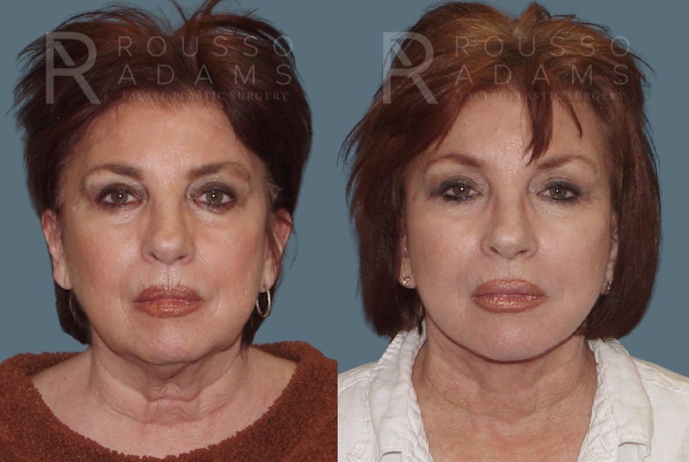 Before & After Image