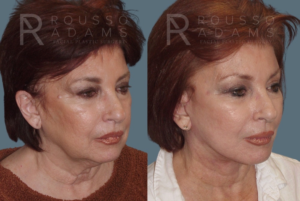 SculptLift™<span class=small>By Dr. Austin Adams</span> Before & After Gallery - Patient 420810 - Image 2