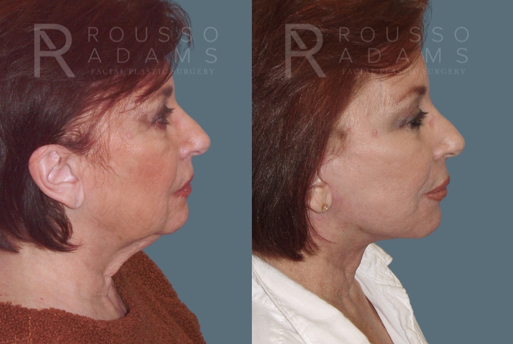 SculptLift™<span class=small>By Dr. Austin Adams</span> Before & After Gallery - Patient 420810 - Image 3