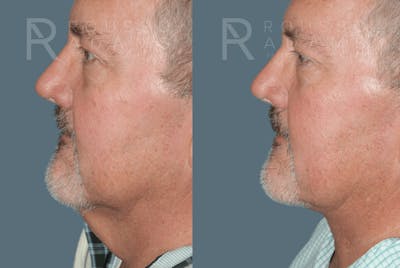 Male Facelift <span class=small>By Dr. Daniel Rousso</span> Before & After Gallery - Patient 895733 - Image 2