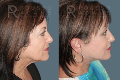 SculptLift™ <span class=small>By Dr. Daniel Rousso</span> Before & After Gallery - Patient 418649 - Image 2