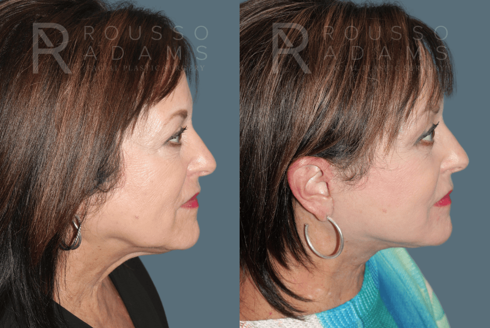 SculptLift™ <span class=small>By Dr. Daniel Rousso</span> Before & After Gallery - Patient 418649 - Image 2