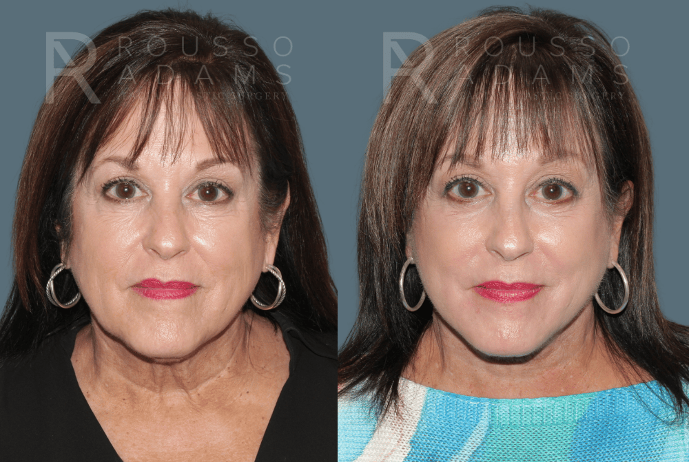 SculptLift™ <span class=small>By Dr. Daniel Rousso</span> Before & After Gallery - Patient 418649 - Image 1