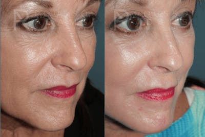 SculptLift™ <span class=small>By Dr. Daniel Rousso</span> Before & After Gallery - Patient 418649 - Image 4