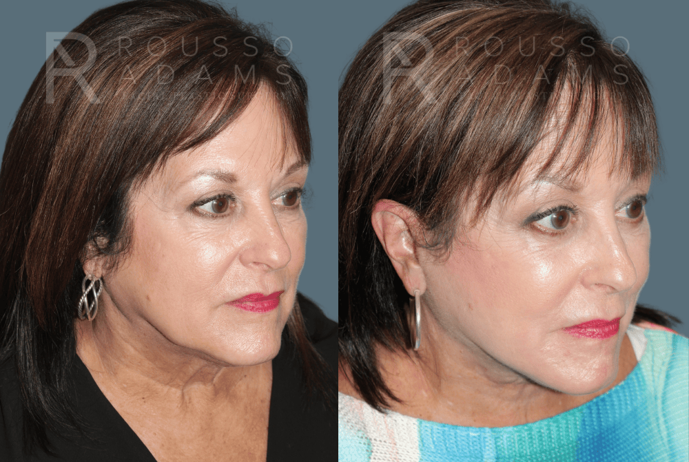 SculptLift™ <span class=small>By Dr. Daniel Rousso</span> Before & After Gallery - Patient 418649 - Image 3