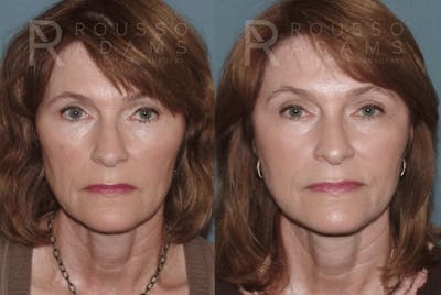 Skin Rejuvenation <span class=small>By Dr. Daniel Rousso</span> Before & After Gallery - Patient 231434 - Image 1