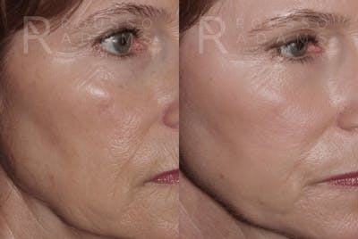 Skin Rejuvenation <span class=small>By Dr. Daniel Rousso</span> Before & After Gallery - Patient 231434 - Image 2