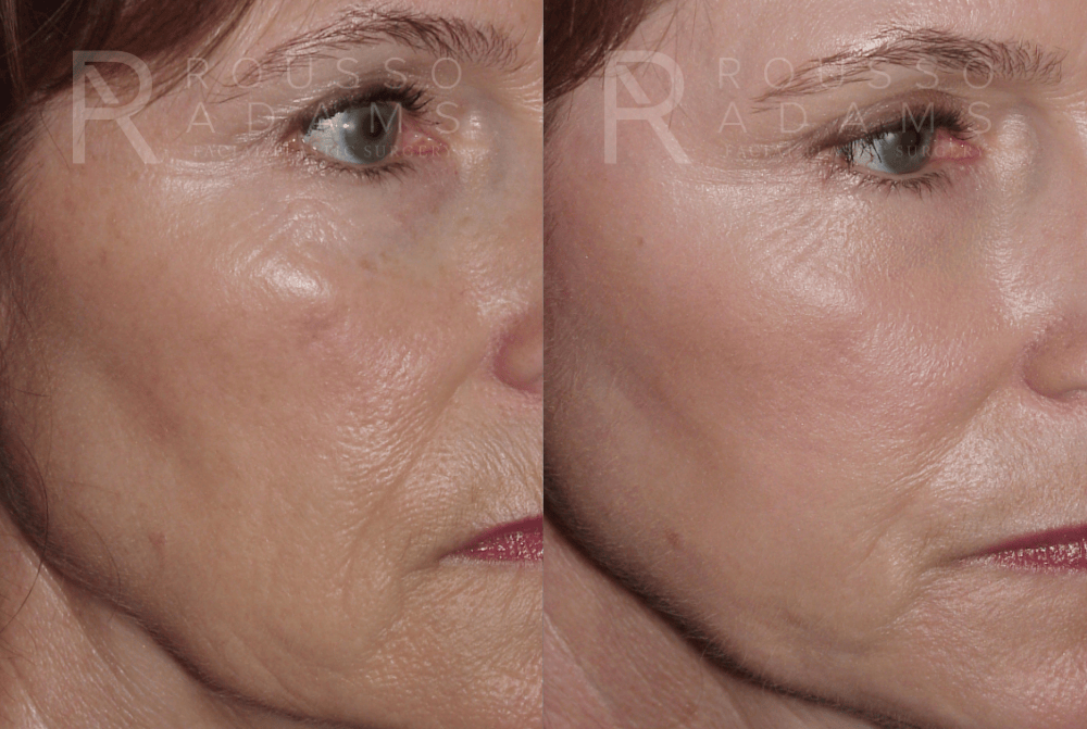 Skin Rejuvenation <span class=small>By Dr. Daniel Rousso</span> Before & After Gallery - Patient 231434 - Image 2
