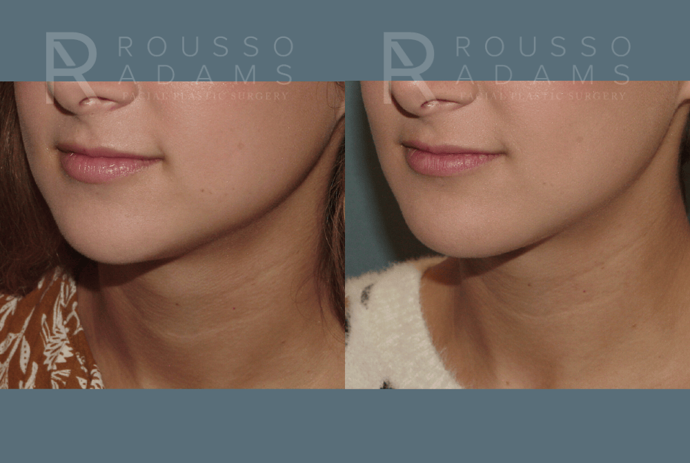 Acculift <span class=small>By Dr. Austin Adams</span> Before & After Gallery - Patient 274391 - Image 3