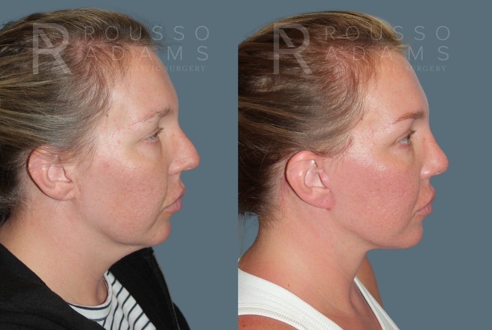 MiniLift<span class=small>By Dr. Austin Adams</span> Before & After Gallery - Patient 244599 - Image 3