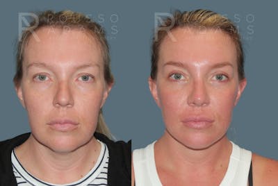 MiniLift<span class=small>By Dr. Austin Adams</span> Before & After Gallery - Patient 244599 - Image 1