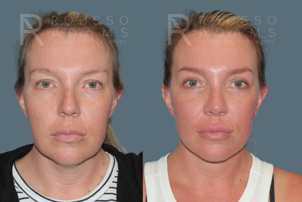 MiniLift<span class=small>By Dr. Austin Adams</span> Before & After Gallery - Patient 244599 - Image 1