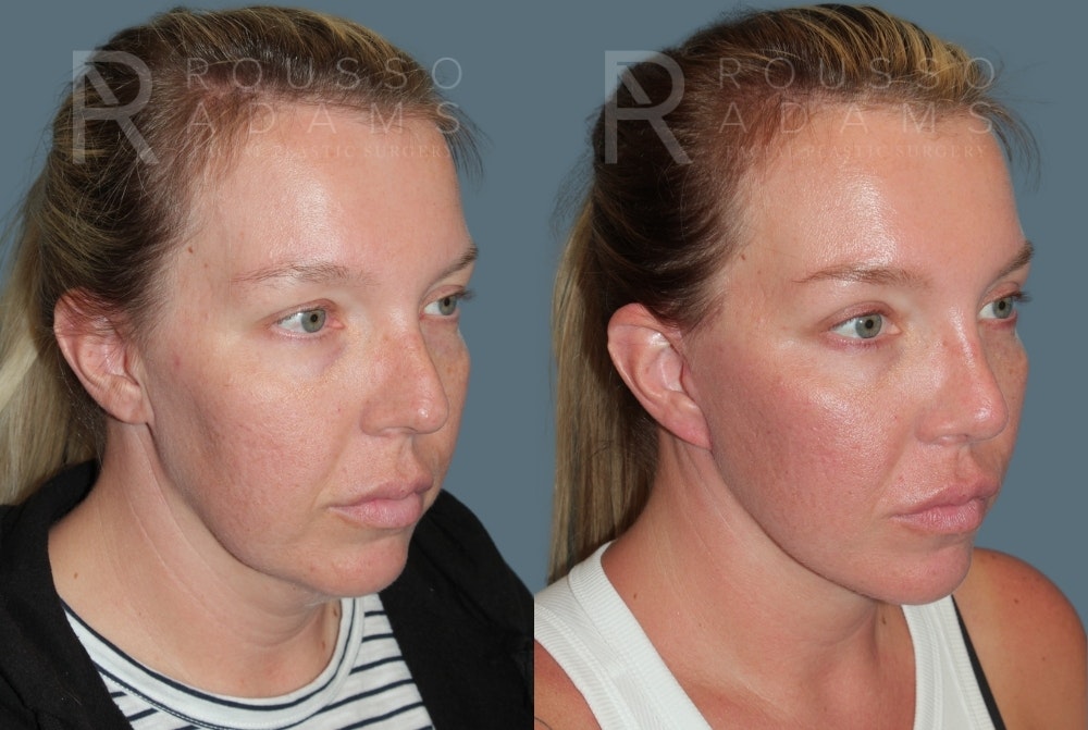MiniLift<span class=small>By Dr. Austin Adams</span> Before & After Gallery - Patient 244599 - Image 2