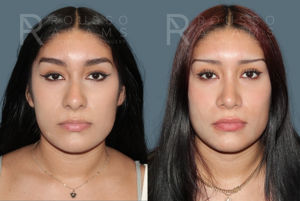 Rhinoplasty<span class=small>By Dr. Austin Adams</span> Before & After Gallery - Patient 103559 - Image 3