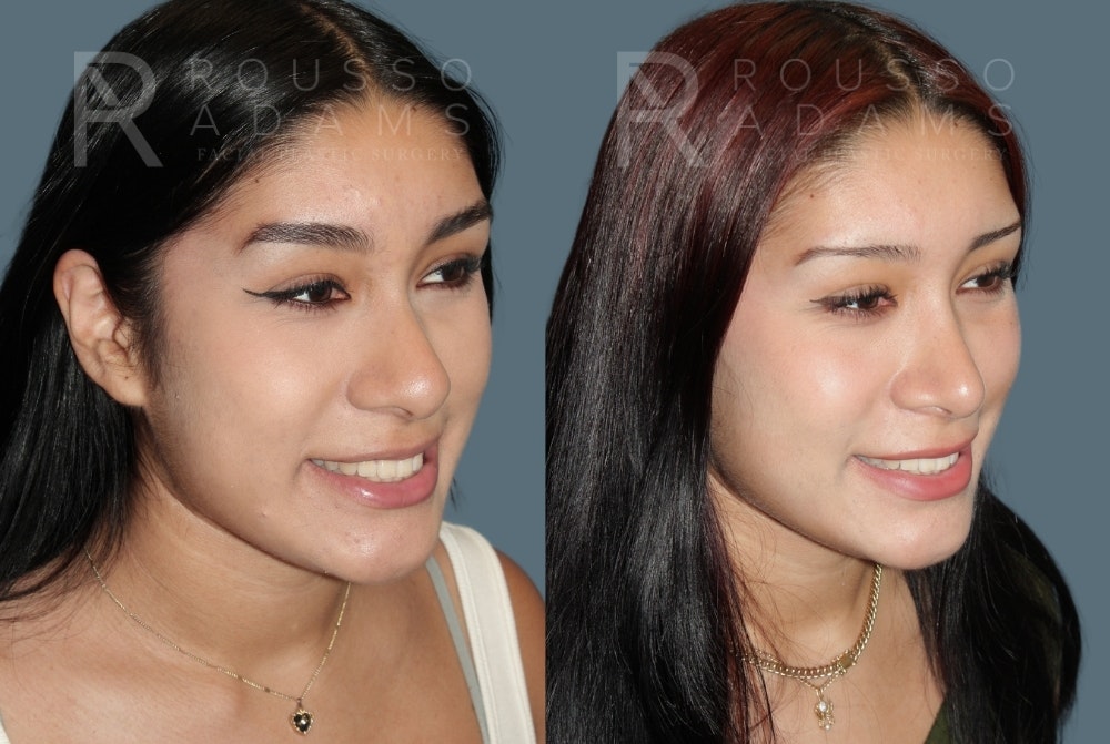Rhinoplasty<span class=small>By Dr. Austin Adams</span> Before & After Gallery - Patient 103559 - Image 2