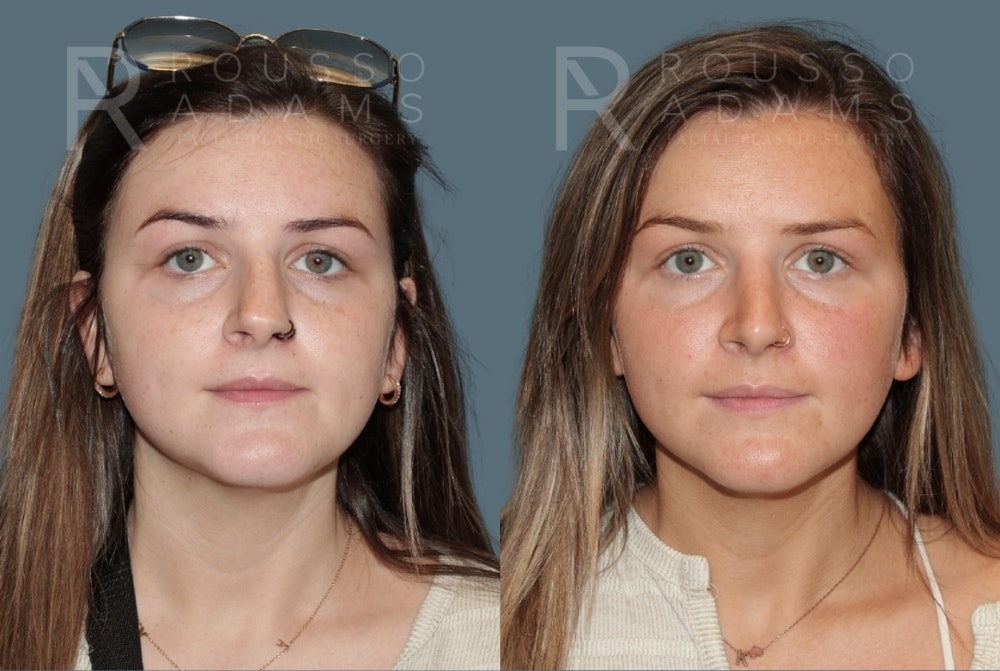 Rhinoplasty<span class=small>By Dr. Austin Adams</span> Before & After Gallery - Patient 277879 - Image 3